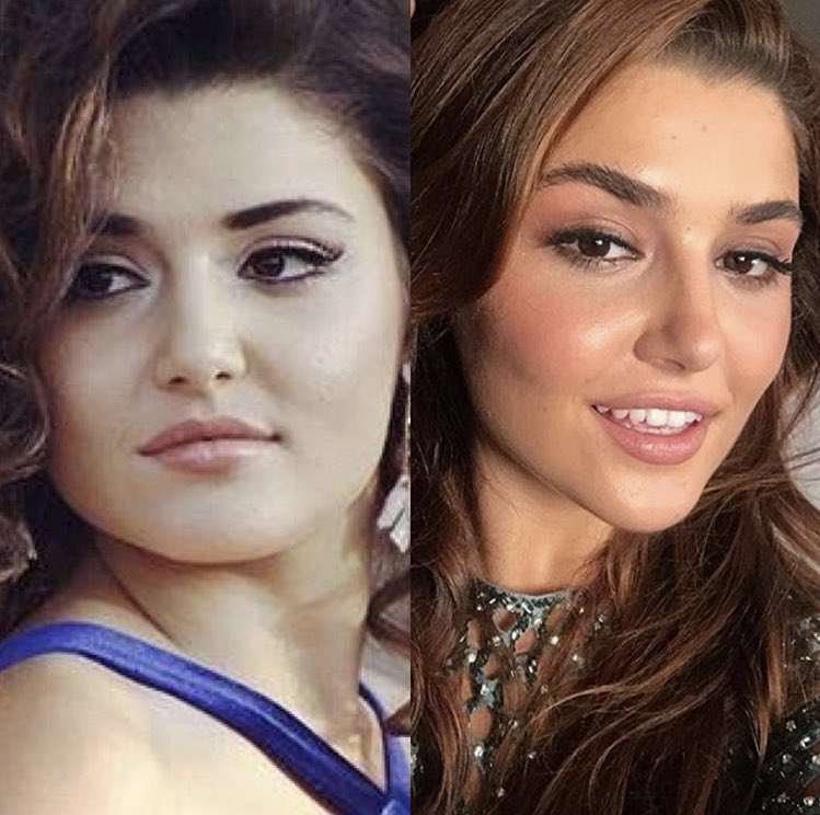 Всегда ли красавицами были? Турецкие актрисы, которые сделали пластику