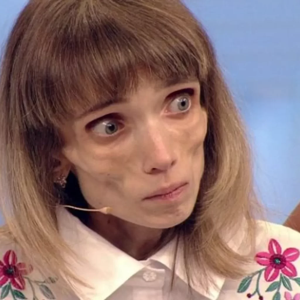 Весила всего 17 кг и напоминала немощную старушку: как сейчас выглядит звезда «Пусть говорят»